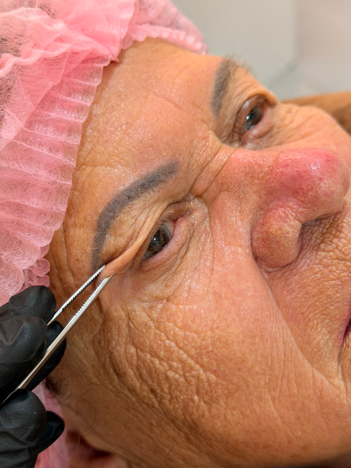 Procedimento de blefaroplastia em andamento, paciente do Instituto 33